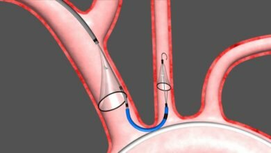 Photo of Embolic Protection Device Material Market Healthcare Equipment, Highlights, Expert Reviews 2020 to 2025